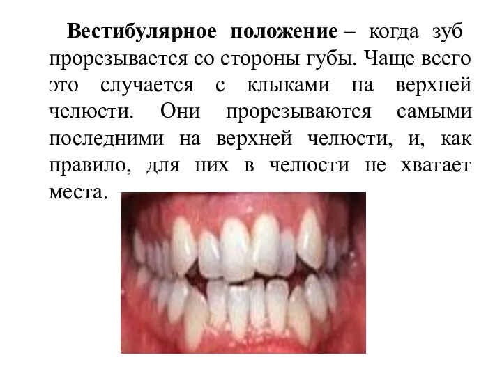 Вестибулярное положение – когда зуб прорезывается со стороны губы. Чаще всего