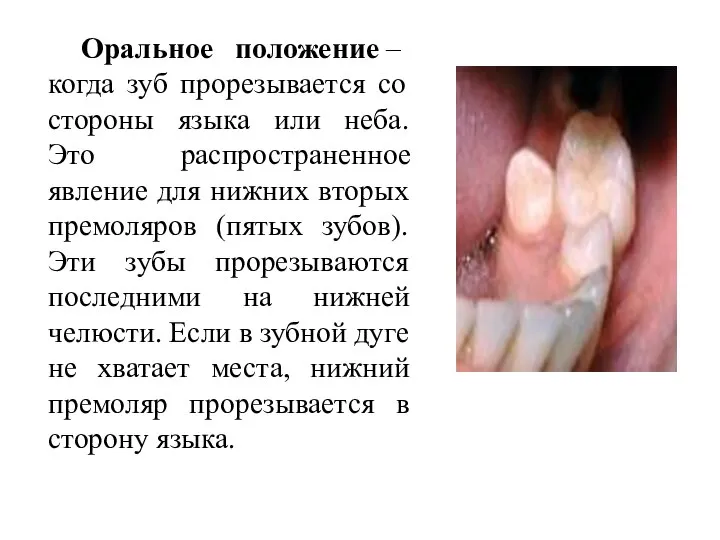 Оральное положение – когда зуб прорезывается со стороны языка или неба.
