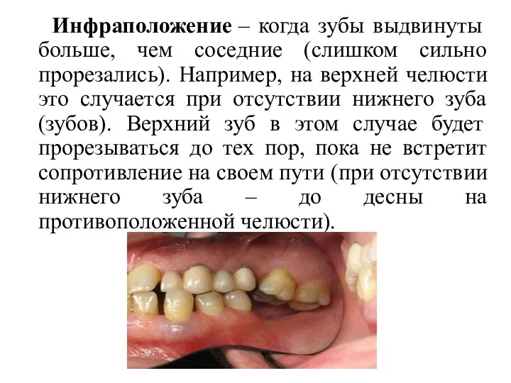 Инфраположение – когда зубы выдвинуты больше, чем соседние (слишком сильно прорезались).