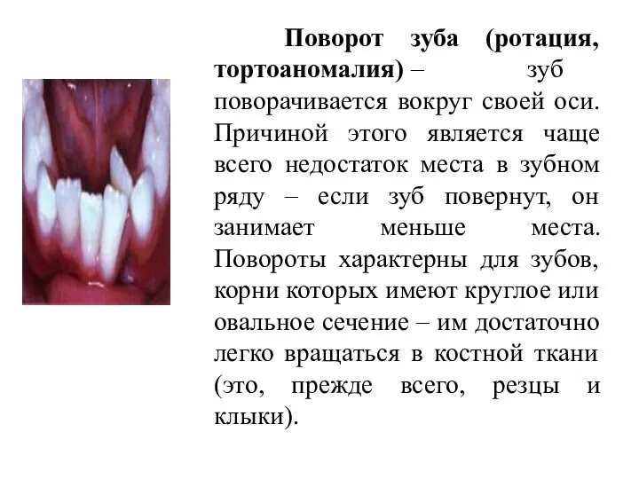 Поворот зуба (ротация, тортоаномалия) – зуб поворачивается вокруг своей оси. Причиной