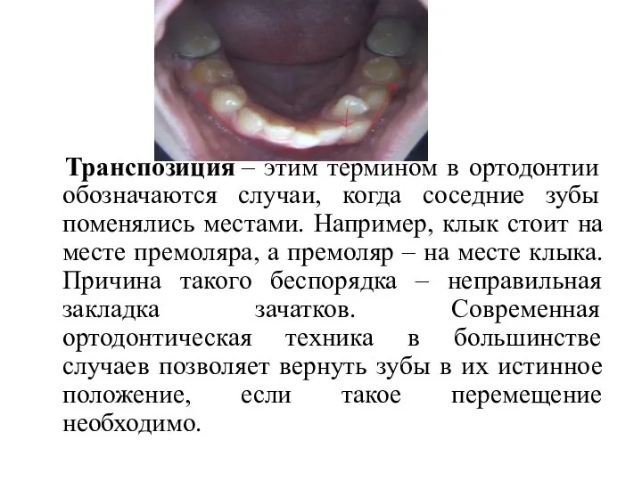 Транспозиция – этим термином в ортодонтии обозначаются случаи, когда соседние зубы