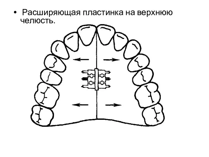 Расширяющая пластинка на верхнюю челюсть.