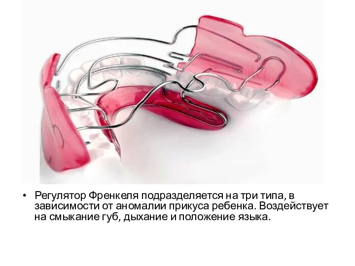 Регулятор Френкеля подразделяется на три типа, в зависимости от аномалии прикуса