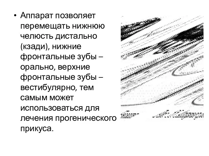 Аппарат позволяет перемещать нижнюю челюсть дистально (кзади), нижние фронтальные зубы –