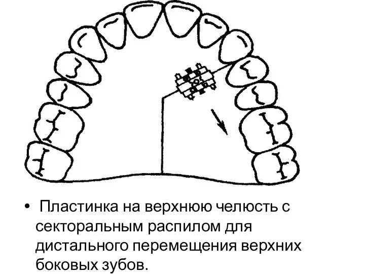 Пластинка на верхнюю челюсть с секторальным распилом для дистального перемещения верхних боковых зубов.