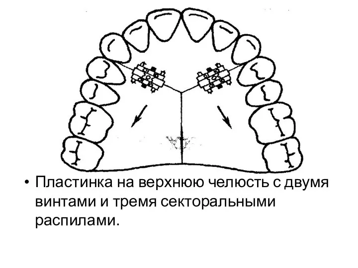 Пластинка на верхнюю челюсть с двумя винтами и тремя секторальными распилами.