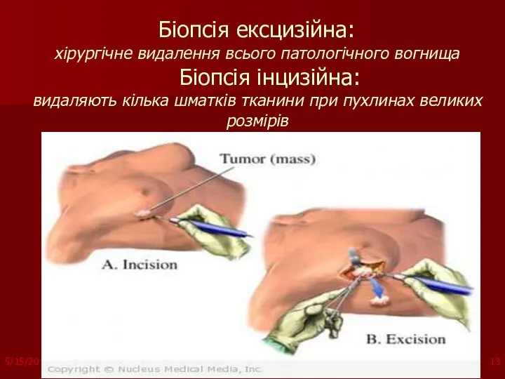 Біопсія ексцизійна: хірургічне видалення всього патологічного вогнища Біопсія інцизійна: видаляють кілька