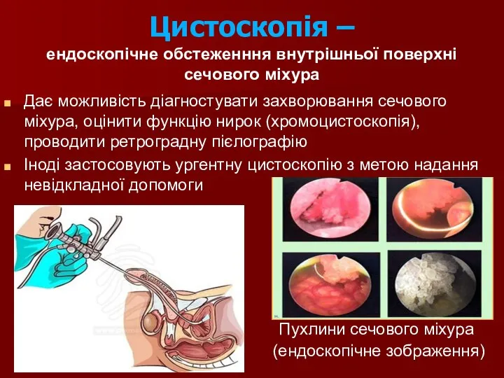 Цистоскопія – ендоскопічне обстеженння внутрішньої поверхні сечового міхура Дає можливість діагностувати