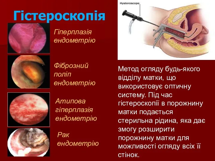 Гістероскопія Гіперплазія ендометрію Фіброзний поліп ендометрію Атипова гіперплазія ендометрію Рак ендометрію