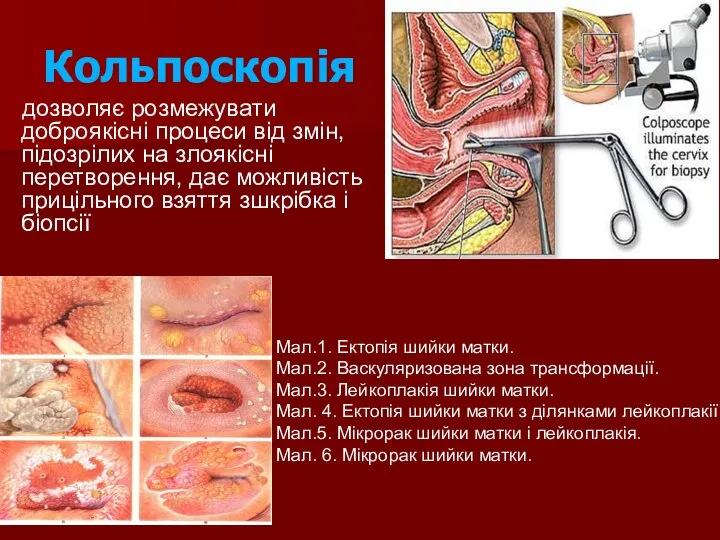 Кольпоскопія дозволяє розмежувати доброякісні процеси від змін, підозрілих на злоякісні перетворення,