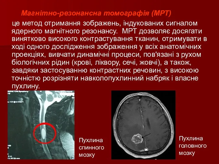 Магнітно-резонансна томографія (МРТ) це метод отримання зображень, індукованих сигналом ядерного магнітного