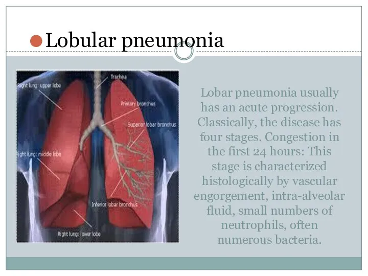 Lobar pneumonia usually has an acute progression. Classically, the disease has