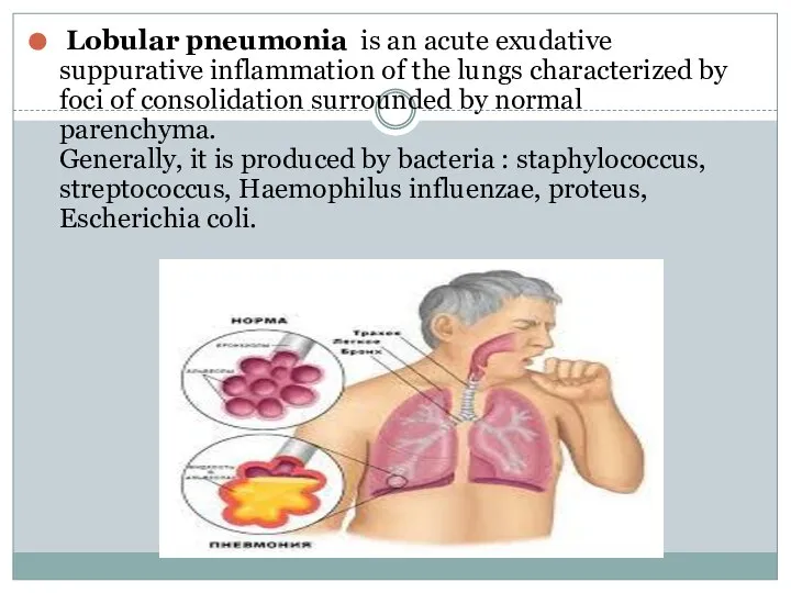 Lobular pneumonia is an acute exudative suppurative inflammation of the lungs