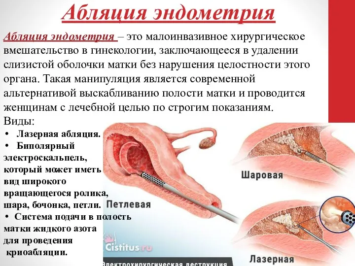 Абляция эндометрия Абляция эндометрия – это малоинвазивное хирургическое вмешательство в гинекологии,