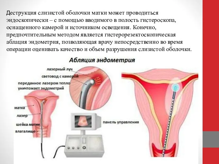 Деструкция слизистой оболочки матки может проводиться эндоскопически – с помощью вводимого