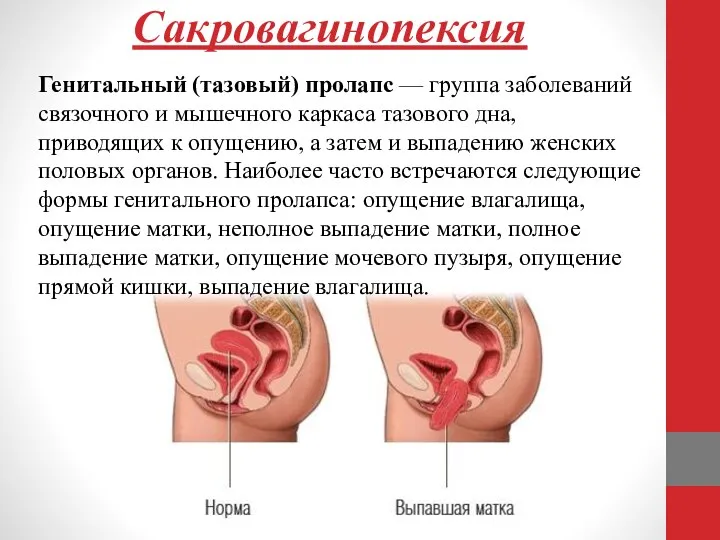 Сакровагинопексия Генитальный (тазовый) пролапс — группа заболеваний связочного и мышечного каркаса