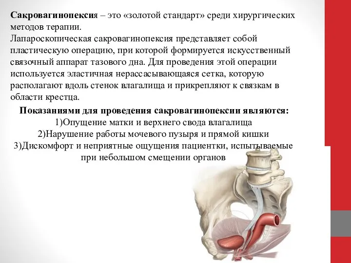 Сакровагинопексия – это «золотой стандарт» среди хирургических методов терапии. Лапароскопическая сакровагинопексия