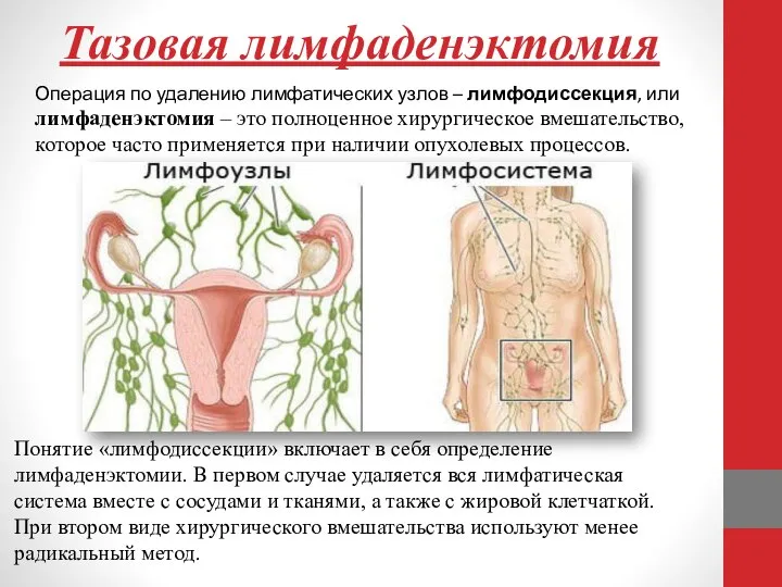 Тазовая лимфаденэктомия Операция по удалению лимфатических узлов – лимфодиссекция, или лимфаденэктомия