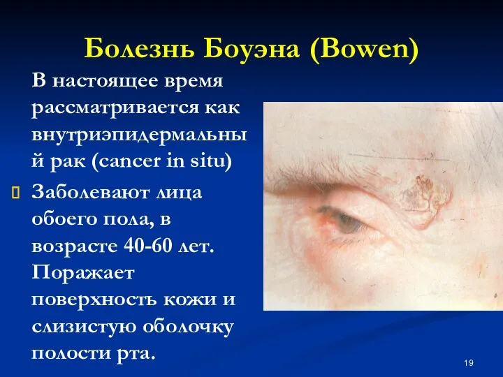Болезнь Боуэна (Bowen) В настоящее время рассматривается как внутриэпидермальный рак (cancer