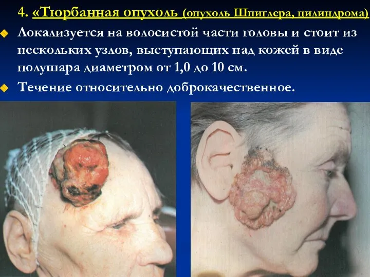 4. «Тюрбанная опухоль (опухоль Шпиглера, цилиндрома) Локализуется на волосистой части головы