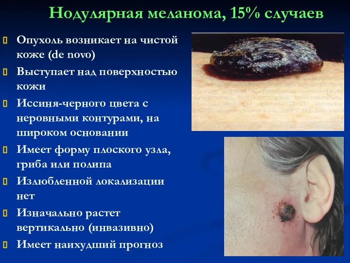 Нодулярная меланома, 15% случаев Опухоль возникает на чистой коже (de novo)