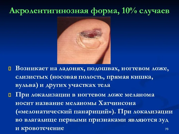 Акролентигинозная форма, 10% случаев Возникает на ладонях, подошвах, ногтевом ложе, слизистых