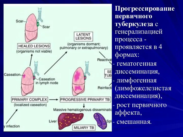 Прогрессирование первичного туберкулеза с генерализацией процесса - проявляется в 4 формах: