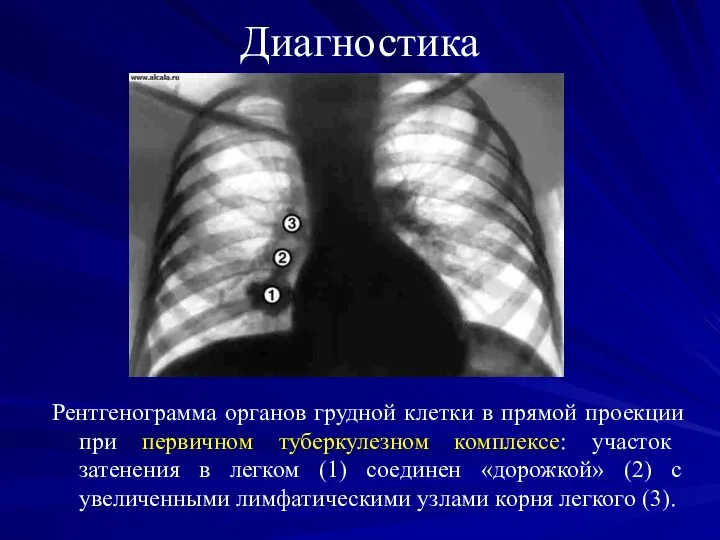 Диагностика Рентгенограмма органов грудной клетки в прямой проекции при первичном туберкулезном