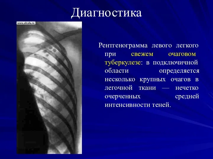 Диагностика Рентгенограмма левого легкого при свежем очаговом туберкулезе: в подключичной области