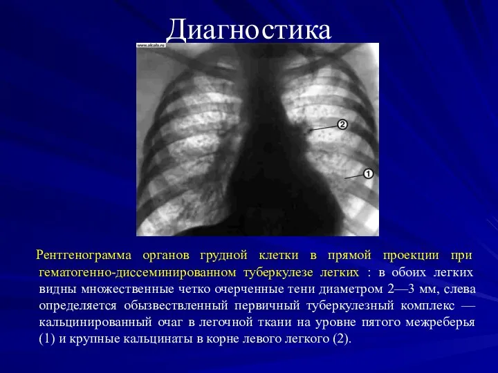 Диагностика Рентгенограмма органов грудной клетки в прямой проекции при гематогенно-диссеминированном туберкулезе