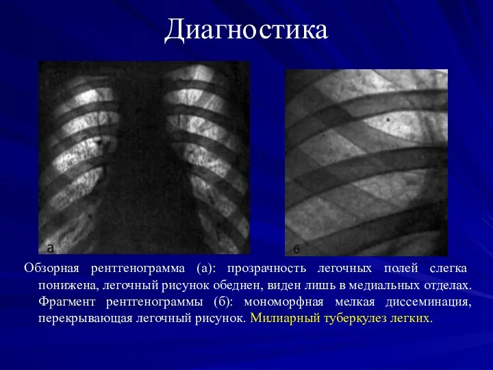 Диагностика Обзорная рентгенограмма (а): прозрачность легочных полей слегка понижена, легочный рисунок