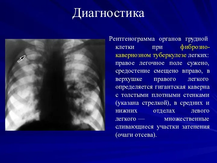 Диагностика Рентгенограмма органов грудной клетки при фиброзно-кавернозном туберкулезе легких: правое легочное