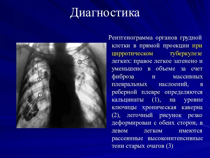 Диагностика Рентгенограмма органов грудной клетки в прямой проекции при цирротическом туберкулезе