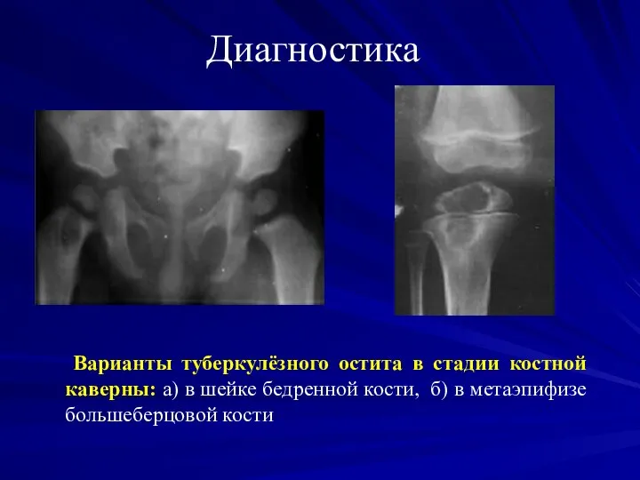 Диагностика Варианты туберкулёзного остита в стадии костной каверны: а) в шейке