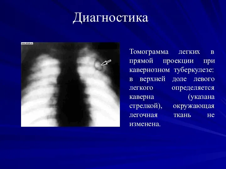 Диагностика Томограмма легких в прямой проекции при кавернозном туберкулезе: в верхней