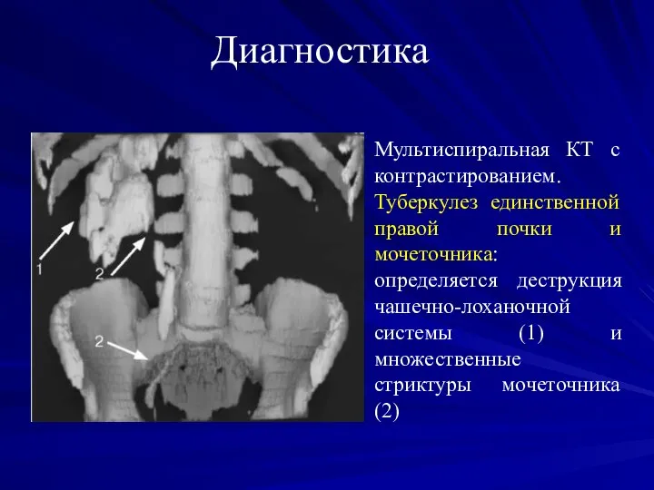 Диагностика Мультиспиральная КТ с контрастированием. Туберкулез единственной правой почки и мочеточника: