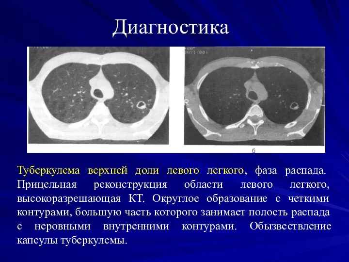 Диагностика Туберкулема верхней доли левого легкого, фаза распада. Прицельная реконструкция области