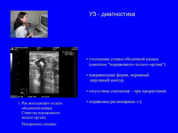 1. Рак восходящего отдела ободочной кишки. Симптом пораженного полого органа. Поперечное