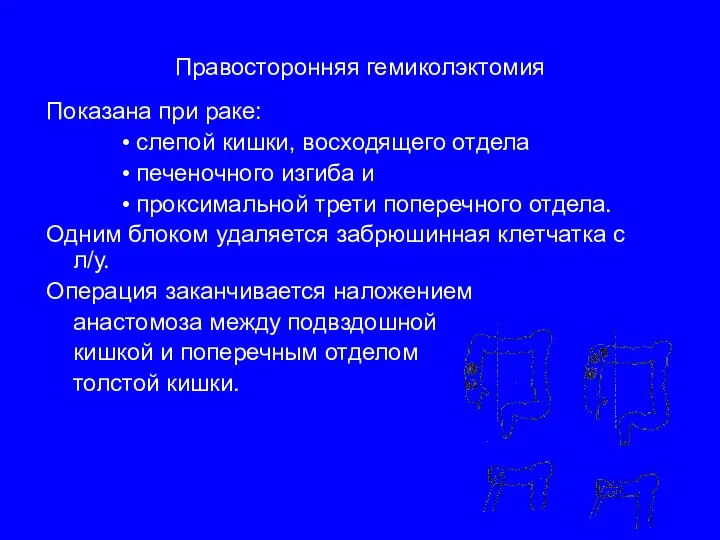 Правосторонняя гемиколэктомия Показана при раке: слепой кишки, восходящего отдела печеночного изгиба