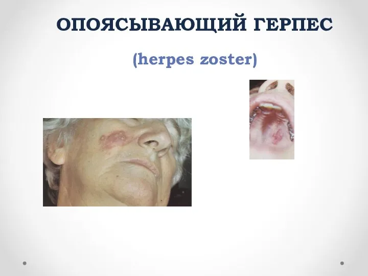 ОПОЯСЫВАЮЩИЙ ГЕРПЕС (herpes zoster)