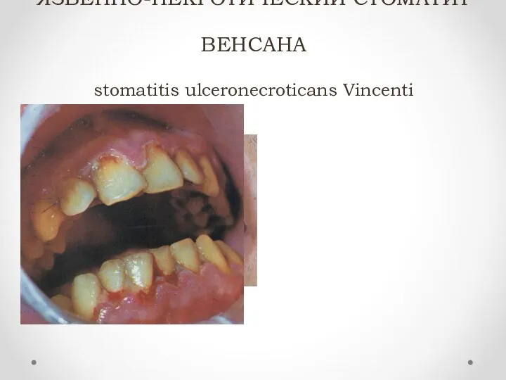 ЯЗВЕННО-НЕКРОТИЧЕСКИЙ СТОМАТИТ ВЕНСАНА stomatitis ulceronecroticans Vincenti