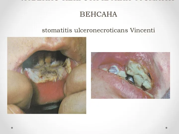 ЯЗВЕННО-НЕКРОТИЧЕСКИЙ СТОМАТИТ ВЕНСАНА stomatitis ulceronecroticans Vincenti