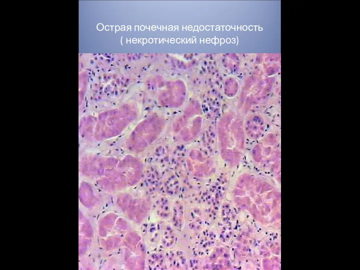 Острая почечная недостаточность ( некротический нефроз)