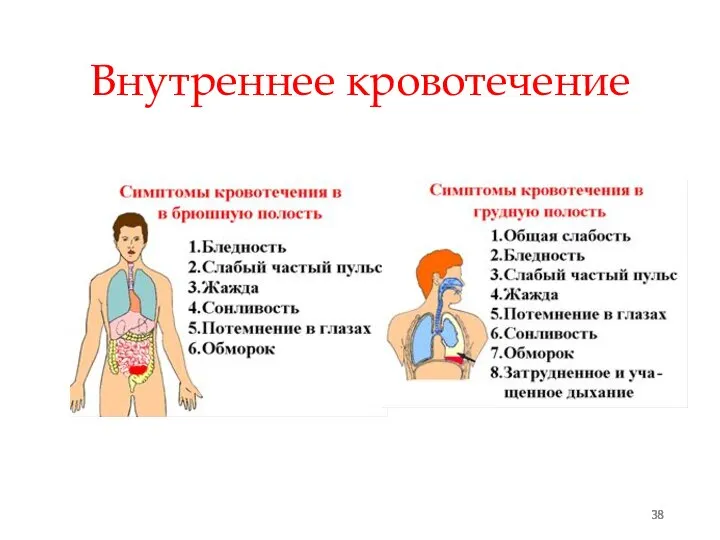 38 Внутреннее кровотечение