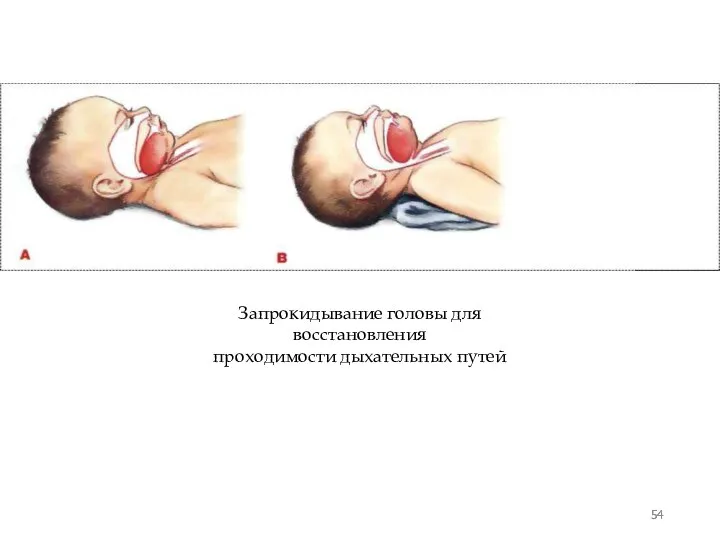 Запрокидывание головы для восстановления проходимости дыхательных путей