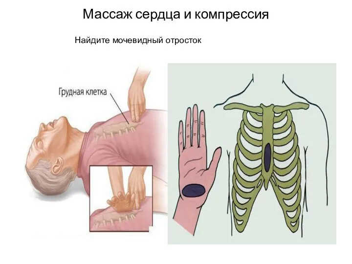 Массаж сердца и компрессия Найдите мочевидный отросток