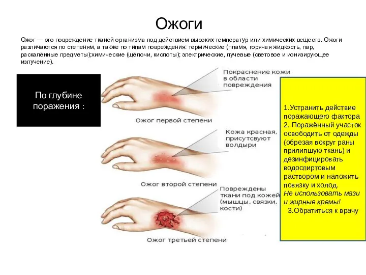 Ожоги Ожог — это повреждение тканей организма под действием высоких температур