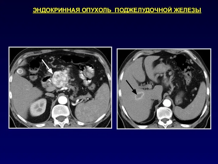ЭНДОКРИННАЯ ОПУХОЛЬ ПОДЖЕЛУДОЧНОЙ ЖЕЛЕЗЫ