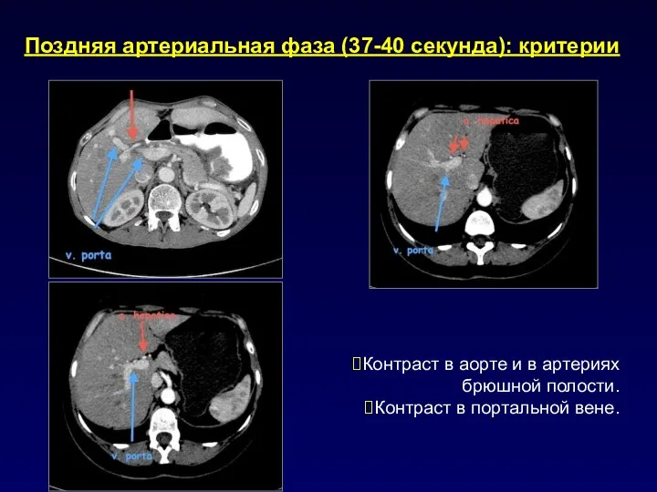 Поздняя артериальная фаза (37-40 секунда): критерии Контраст в аорте и в