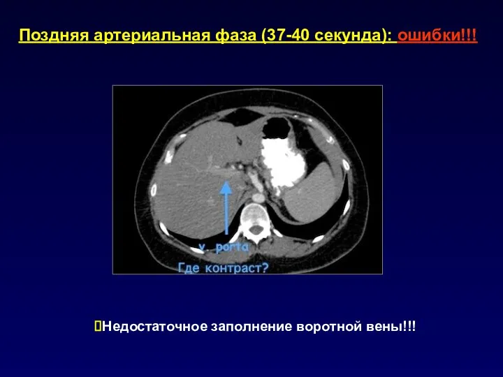 Поздняя артериальная фаза (37-40 секунда): ошибки!!! Недостаточное заполнение воротной вены!!!